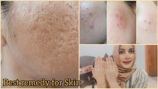 Open pores , Large Pores , Clogged Pores Remedy by momina kiran