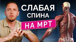 Эволюция подарила нам остеохондроз. Объясняю на МРТ, почему разрастаются суставы и болит спина