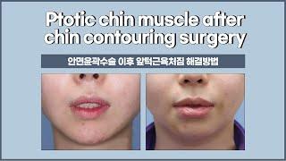 Ptotic chin muscle after chin contouring surgery (앞턱윤곽수술 이후 앞턱근육처짐 해결방법) Advancement osteotomy