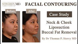 Watch a Facial Contouring Procedure I NYC Plastic Surgeon Dr. Thomas P. Sterry