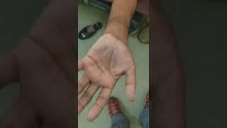 brachial artery aneurysm
