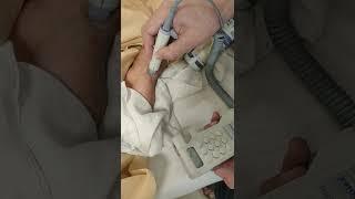 irregular pulse radial