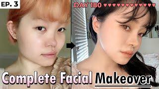 [SUB] Full Facial Plastic Surgery After 6 months in South Korea | REAL before and after REVIEW!