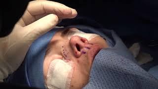 Caucasian Rhinoplasty-19/993:Rhinoplasty Bizrah- London/Dubai- Dr Bashar Bizrah