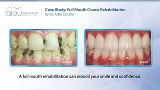 [Bleu Dentistry] Case Study: Full Mouth Crown Rehabilitation