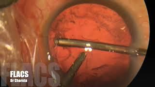 Femtosecond Laser Assisted Cataract Surgery Dr Charuta