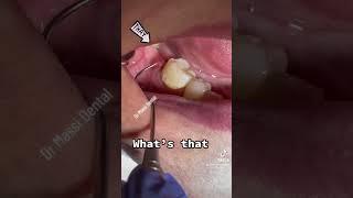 Gum Boil, toot fracture