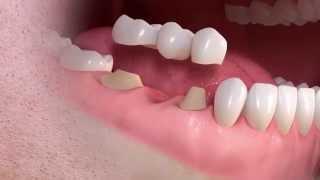 Straumann - Conventional 3-unit bridge treatment