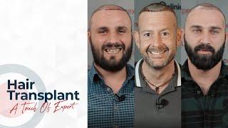 Hair Transplant -  A touch of experts