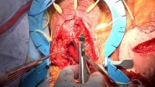 Prelaminated Buccal Mucosa-Gracilis Flap for Reconstruction of Devastated Urethra