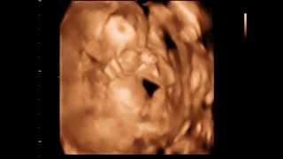 3d ultrasound - 3D Sono Image