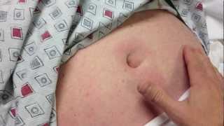 umbilical hernia - with fat herniation