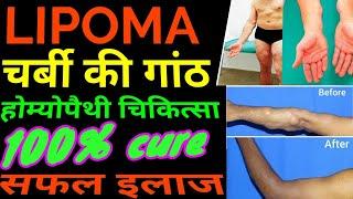 LIPOMA (चर्बीकीगांठ) best homeopathic treatment for lipoma in hindi drrajeshmanghnani #ehomeovision