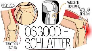 Osgood Schlatter Disease Made Easy (Tibial Tubercle Apophysitis)