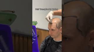 Hair Transplant in Turkey | Hair Transplant Process #hairtransplant