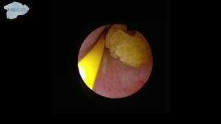 Localization of the ureter stone