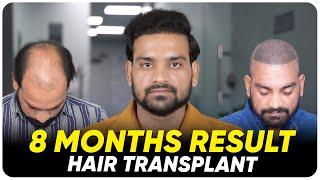 Hair Transplant in Bangalore | Best Results & Cost of Hair Transplant in Bangalore