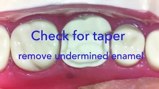 MOD Ceramic Onlay on a Maxillary First Molar | Columbia Tooth