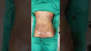 360 Abdominal Liposuction #cosmeticsurgery #drprashantyadav #shortvideo