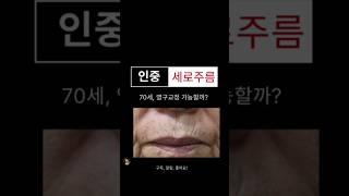 깊은 인중세로주름, 얼마나 좋아질까? #입술고양이주름 #신촌성형외과 #연세자연미