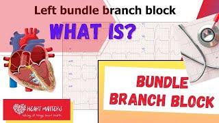 What is a bundle branch block and is it serious?