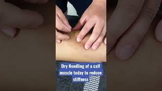 Calf muscle dry needling with muscle twitch to reduce stiffness