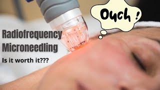Radiofrequency Microneedling | Does it actually work? | Dermatologist reviews
