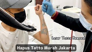 Hapus Tatto Murah Wilayah Jakarta Indonesia | Laser Tatto Removal Indonesian