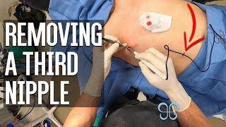 Male Nipple Reduction & Removal of Third Nipple | Brown Plastic Surgery