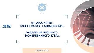 Лапароскопія  Консервативна міомектомія  Видалення низького заочеревинного вузла