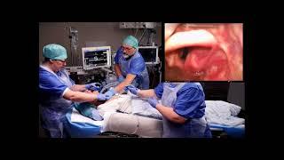 VIDEO LARYNGOSCOPE GUIDED INTUBATION