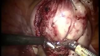 Myomectomy Enucleation 2 OBG MANAGEMENT