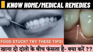 दो दांतों के बीच खाना फंसता है क्या है इसका उपाय-Food stuck in between 2 teeth #proximalspace