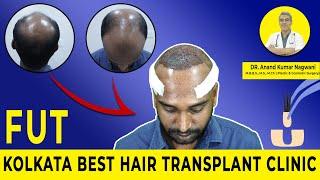 BEST HAIR TRANSPLANT SURGERY IN KOLKATA | GRADE-7 |  FUT HAIR TRANSPLANT