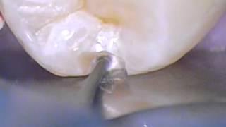 Boca Raton Cosmetic Dentistry Conservative Tooth Colored Resin Filling 1 - Preparation