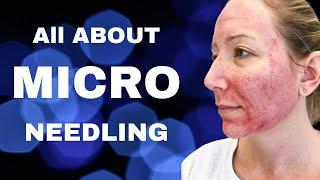 Is Microneedling Worth It , Dr. Messina of Long Island Explains