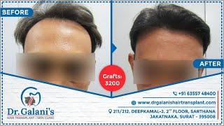 Best Hair Transplant In Surat 2021 | Fue - No Root Touch Surgery | Before And After 3200 Grafts