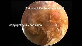 Plain cerumen and external auditory canal cholesteatoma re cleaned, 13 minutes