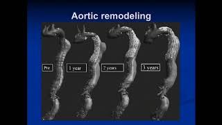 TEVAR for Type II Aortic Dissection – When and Why - Norman Kumins, MD