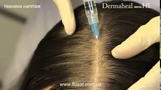 Восстановление роста волос препаратом Dermaheal HL [ FloSal ]