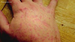 Virginia Department of Health investigating potential measles exposure at Dulles Airport this week