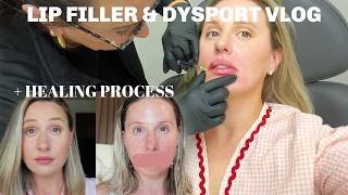 lip filler & dysport (completely painless) + healing process, cost & everything you need to know!