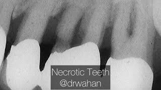 Loose Bridge with Necrotic Teeth Extractions