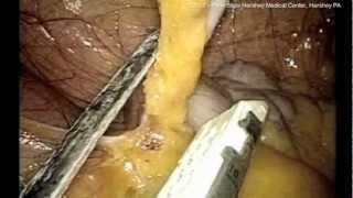 Laparoscopic appendectomy: Resect the appendix