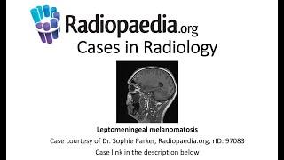 Leptomeningeal melanomatosis (Radiopaedia.org) Cases in Radiology