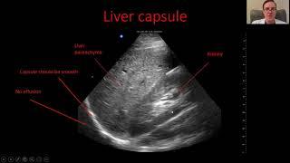 Liver Ultrasound Exam with the Butterfly iQ