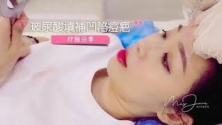 玻尿酸填充使凹陷型痘疤瞬間平滑！| Cosmetic Filler | MayJune Shines |