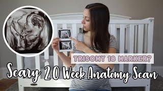 Scary 20 Week Anatomy Scan | Trisomy 18 Marker?