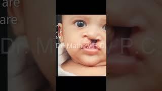 Complete Cleft Lip and Palate Correction in India | One Day Result After Surgery #shorts