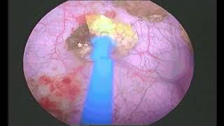 Urinary bladder Stone By Laser